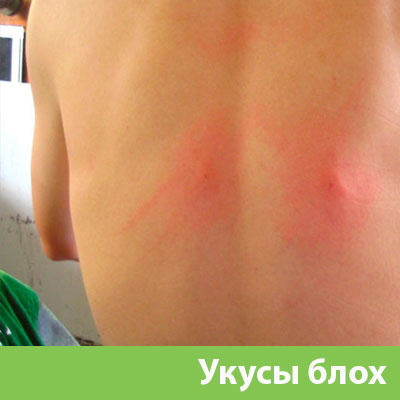 Укусы блох в Бийске