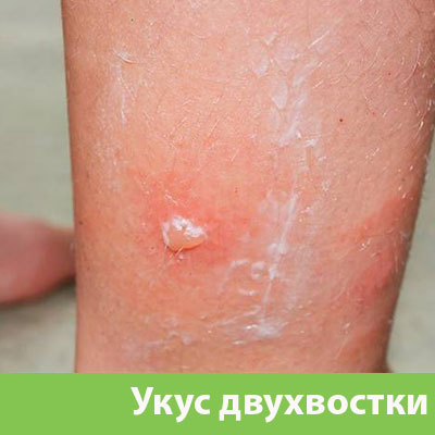 Укус двухвостки в Бийске