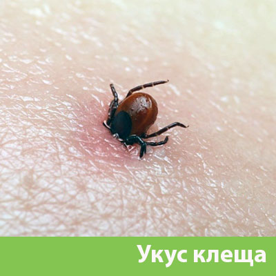 Укус клеща в Бийске