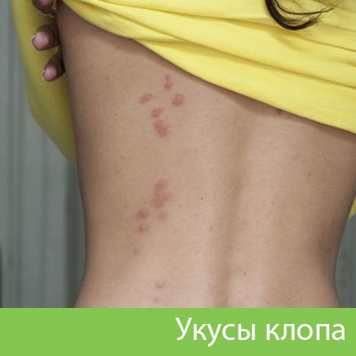 Профессиональное уничтожение клопов в Бийске